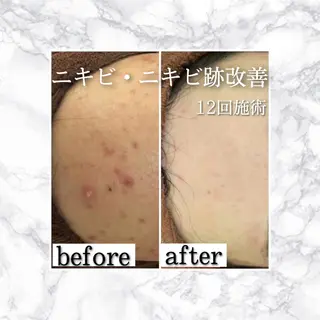 セミロング カラー パーマ ヘアアレンジ メンズ キッズ ネイル マツエク・マツパ アイブロウ ニキビ特化型エステ 🍓最短で肌質改善のエステ・リラクイメージ