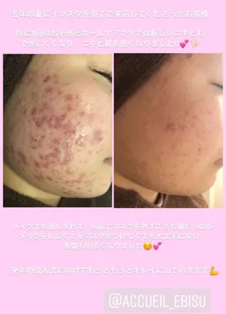 ミディアム カラー パーマ ヘアアレンジ メンズ キッズ ネイル マツエク・マツパ ニキビ・肌質改善専門 ♡人生が変わるサロンのエステ・リラクイメージ