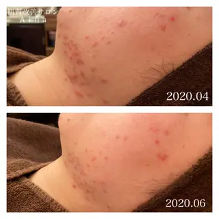 ショート カラー パーマ ヘアアレンジ メンズ ネイル マツエク・マツパ ニキビ跡専門サロン Ainaのエステ・リラクイメージ