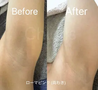 川越ローマピンク 光脱毛＆ワックス脱毛のエステ・リラクイメージ