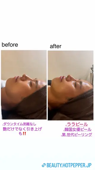 ハーブピーリング/韓国肌管理/フェイシャル/毛穴洗浄/眉毛/顔脱毛【糸脱毛専門】rev所属・ハーブピーリング🌹 毛穴洗浄❤️眉waxのエステ・リラクイメージ