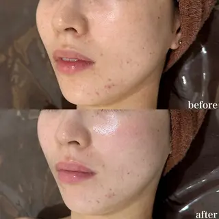 mieux所属・ハーブピーリング ¥6600のエステ・リラクイメージ