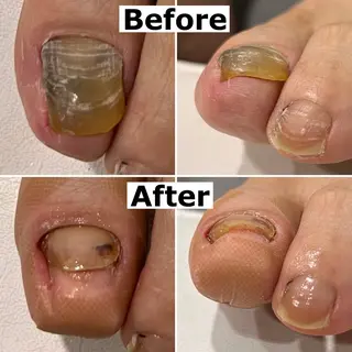 ネイル Mellow nail所属・巻爪無料モデル募集 ✨🦶MEGUMIのネイルデザイン