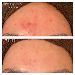 セミロング カラー パーマ ヘアアレンジ メンズ ネイル マツエク・マツパ ニキビ跡専門サロン Ainaのエステ・リラクイメージ