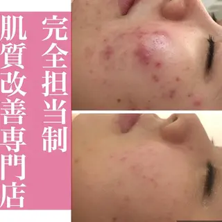 🔥3か月で肌革命 🔥ニキビ専門店のエステ・リラクイメージ