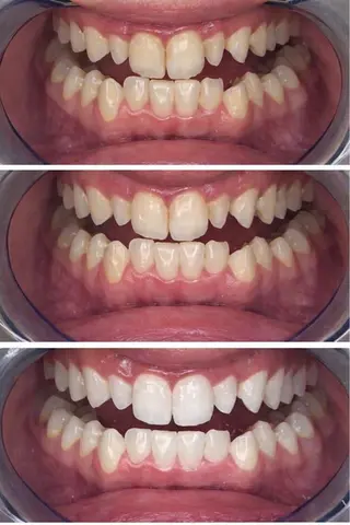 マツエク・マツパ プラチナムビューティー柏所属・【歯科提携】柏ホワイ トニングスタイルのその他イメージ