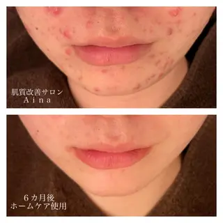 セミロング カラー パーマ ヘアアレンジ メンズ キッズ ネイル マツエク・マツパ ニキビ跡専門サロン Ainaのエステ・リラクイメージ