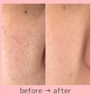 ポーラ心斎橋御堂筋店所属・小顔毛穴/POLA 心斎橋難波5分のその他イメージ