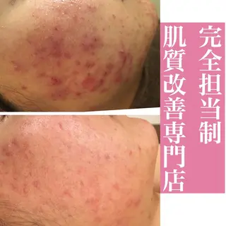 ミディアム カラー パーマ ヘアアレンジ メンズ キッズ ネイル マツエク・マツパ アイブロウ ニキビ・肌質改善専門 ♡人生が変わるサロンのエステ・リラクイメージ