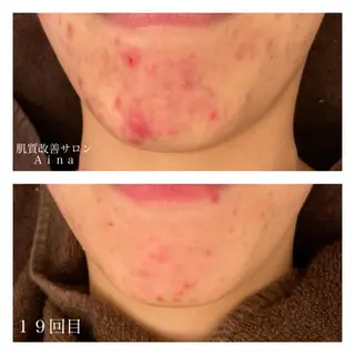 ミディアム カラー パーマ ヘアアレンジ メンズ キッズ ネイル マツエク・マツパ ニキビ跡専門サロン Ａｉｎａのエステ・リラクイメージ