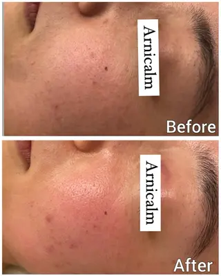 ハーブピーリング 肌再生ピーリング/のエステ・リラクイメージ