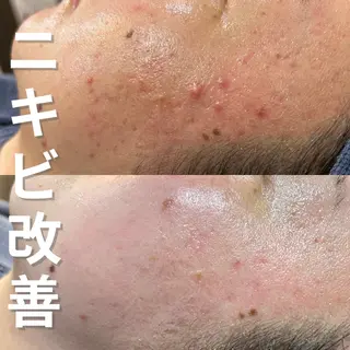 ニキビ・ニキビ跡改善 leoloのエステ・リラクイメージ