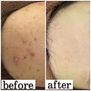 セミロング カラー パーマ ヘアアレンジ メンズ キッズ ネイル マツエク・マツパ アイブロウ ニキビ特化型エステ 🍓最短で肌質改善のエステ・リラクイメージ