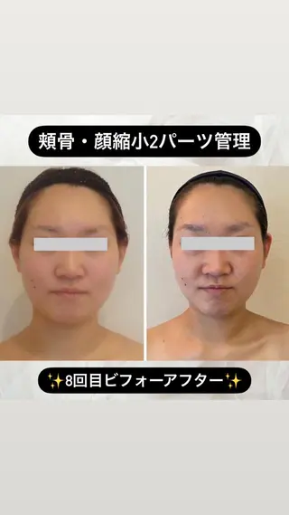 整形級の変化👀 最新✨韓国小顔管理のエステ・リラクイメージ