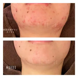 セミロング カラー パーマ ヘアアレンジ メンズ キッズ ネイル マツエク・マツパ ニキビ跡専門サロン Ainaのエステ・リラクイメージ