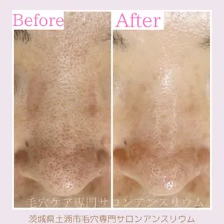 毛穴ケア専門サロンアンスリウム所属・茨城土浦 つくば毛穴 ケア専門サロンのエステ・リラクイメージ