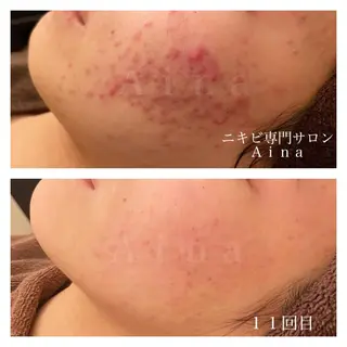 ミディアム カラー パーマ ヘアアレンジ メンズ キッズ ネイル マツエク・マツパ ニキビ跡専門サロン Ainaのエステ・リラクイメージ