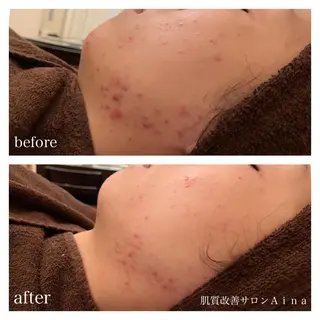 セミロング パーマ キッズ ネイル マツエク・マツパ ニキビ跡専門サロン Ａｉｎａのエステ・リラクイメージ