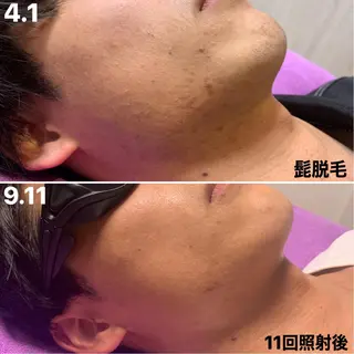 メンズ 脱毛＆エステサロン【アンリミット】所属・森谷 莉美のエステ・リラクイメージ