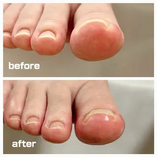 巻き爪フットケアサロンKotori所属・フットケアサロン Kotoriのその他イメージ