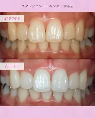 エクシアホワイト調布所属・umi❤︎ ホワイトニングのその他イメージ