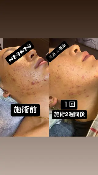 メンズ脱毛サロン　Leaf所属・脱毛サロンLeaf 笠原のエステ・リラクイメージ