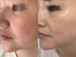 ネイル aliaハイフ&水光ジェットサロン所属・aliaハーブ水光店 エステティシャン募集のエステ・リラクイメージ