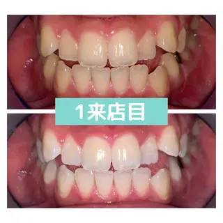 ホワイトニング｜韓国式3D毛穴洗浄 lonhana ﾛﾝﾊﾅ所属・韓国式3D毛穴洗浄 lonhanaのその他イメージ