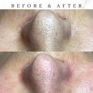 セルフエステエンリケ明石大久保店所属・夕希 毛穴と脱毛特化サロンのエステ・リラクイメージ