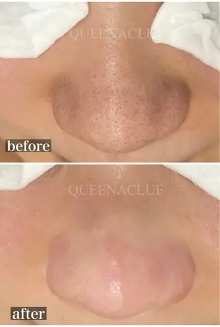 毛穴改善/脱毛 ネイル　川上久仁子のエステ・リラクイメージ