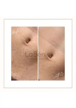 メンズ 脱毛/美肌【皮膚科看 護師経営】ラベニールのエステ・リラクイメージ