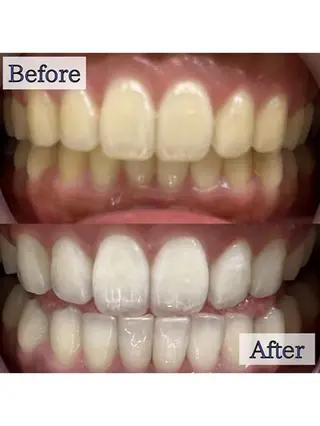 LBSホワイトニング上野店所属・LBSホワイトニング 🌐 上野店公式のエステ・リラクイメージ