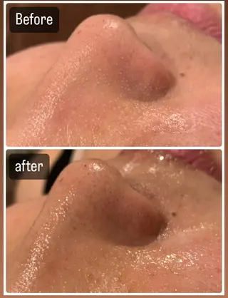 肌質改善ハーブピー リング🌿RINAのエステ・リラクイメージ