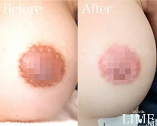 ハーブピーリング LIME池袋東口のエステ・リラクイメージ