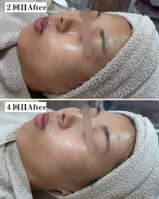 |ピーリング・毛穴| soina神楽坂のエステ・リラクイメージ