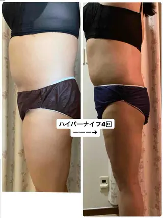 廋身·ハイパーナフ 腸·ヘッドスパ💎モのエステ・リラクイメージ