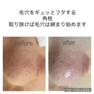 毛穴ケア・肌質改善 徳川のエステ・リラクイメージ