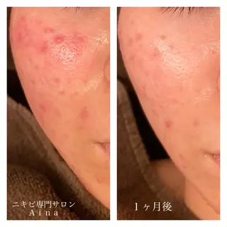 セミロング カラー パーマ ヘアアレンジ メンズ キッズ ネイル マツエク・マツパ ニキビ跡専門サロン Ainaのエステ・リラクイメージ