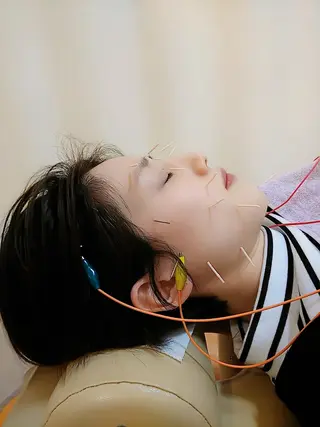 リフトアップ・たるみ ☆美容鍼小顔矯正のその他イメージ