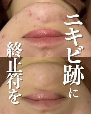 ニキビ特化型エステ 🍓最短で肌質改善のエステ・リラクイメージ
