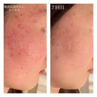 セミロング カラー パーマ ヘアアレンジ メンズ キッズ ネイル マツエク・マツパ ニキビ跡専門サロン Ainaのエステ・リラクイメージ