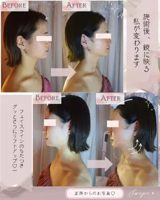 痩身ハーブピーリング 筋膜リリース☆B&Hのエステ・リラクイメージ