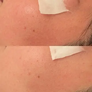 毛穴ケア/毛穴診断/ 毛穴洗浄〔心斎橋〕のエステ・リラクイメージ