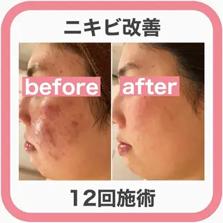 ニキビ特化型エステ 🍓最短で肌質改善のエステ・リラクイメージ