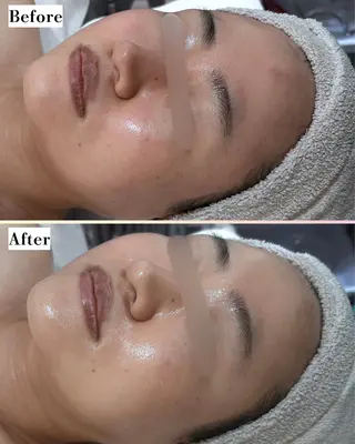 |ピーリング・毛穴| soina神楽坂のエステ・リラクイメージ