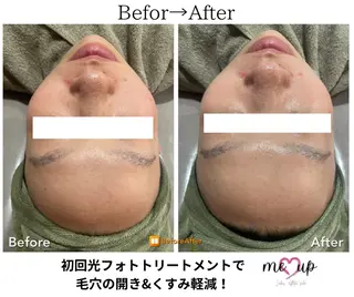 Meupニキビ専門店 背中/ハーブ/肌管理のその他イメージ