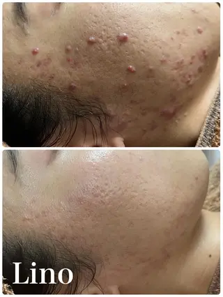 beautysalon LINO所属・平日昼間限定★ 全メニュ¥6600のエステ・リラクイメージ