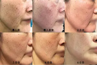 ニキビ&跡改善サロン オーナー光木のエステ・リラクイメージ