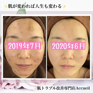 ミディアム カラー パーマ ヘアアレンジ メンズ キッズ ネイル マツエク・マツパ アイブロウ ニキビ・肌質改善専門 ♡人生が変わるサロンのエステ・リラクイメージ