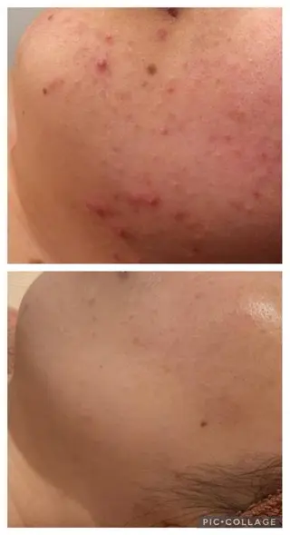 セミロング カラー パーマ ヘアアレンジ メンズ キッズ ネイル マツエク・マツパ アイブロウ ニキビ特化型エステ 🍓最短で肌質改善のエステ・リラクイメージ